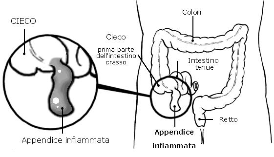 appendicite